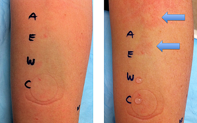 (Left) Patient's forearm before a cold challenge test. Letter A represents area of the arm where drop of water was placed. (Right) Patient's forearm after the test. Blue arrows point to red hives that have formed after the water is placed on the arm and cold air is blown across it. Photo courtesy of NIAID.