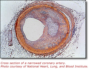 Cross section of a narrowed coronary artery. Photo courtesy of National Heart, Lung, and Blood Institute