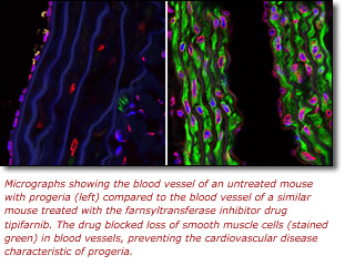 Photomicrographs showing the blood vessel of an untreated mouse with progeria (left) compared to the blood vessel of a similar mouse treated with the farnsyltransferase inhibitor drug tipifarnib. The drug blocked loss of smooth muscle cells (stained green) in blood vessels, preventing the cardiovascular disease characteristic of progeria.