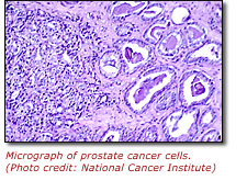 Histological slide (H & E stain at x300) showing prostate cancer.