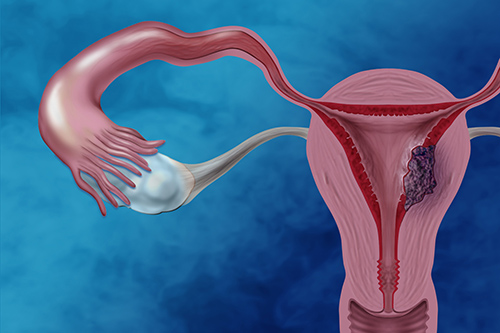 Endometrial cancer is the most commonly diagnosed gynecological cancer. Women with clear cell endometrial cancer, a rare type of endometrial cancer, generally have poorer clinical outcomes. Image Credit: Darryl Leja, NHGRI.