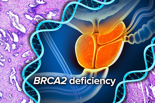 An illustration of B R C A 2 deficiency.