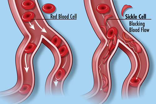 Normal blood cells (left) and the blood cells in Sickle cell disease, which do not flow through the circulatory system smoothly. Credit: Darryl Leja, NHGRI.