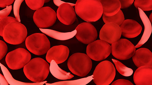Insights into Microbiome and Environmental Contributions to Sickle Cell Disease and Leg Ulcers Study​ | NHGRI