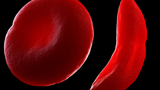 ​Sickle Cell Disease | NHGRI