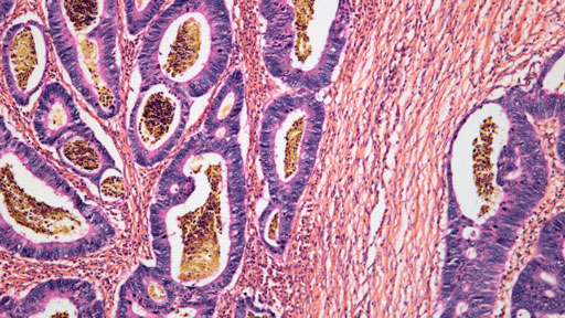 About Colon Cancer | NHGRI