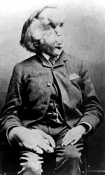 Joseph Merrick. High-resolution available at Wikipedia.