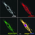 This microscopic image depicts the mitochondria within a skin cell, which appears in white in the top left image. Red that shows up in the top right image and green in the bottom left image highlights ACSF3, the cause of CMAMMA. ACSF3 is localized to the mitochondria. The bottom right image is a composite of the three views