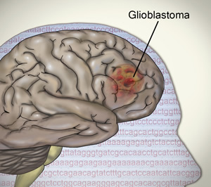 Glioblastoma - Brain tumor illustrated