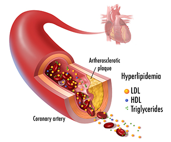 Hyperlipidemia