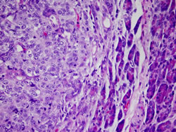 Micrograph of metastatic melanoma cells, left, that have invaded pancreatic tissue, right