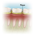 Dental plaque illustrated