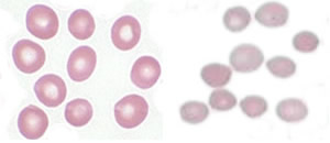 Healthy red blood cells, left, are disk shaped and transport oxygen through narrow blood vessels. Red blood cells with deficient amkyrin have rigid spherical membrane walls, preventing passage through smaller blood vessels