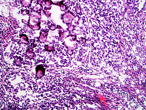 Endometrial tumor cells