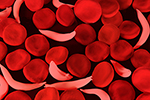 Sickle Cell