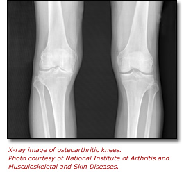 X-ray image of osteoarthritic knees. Photo courtesy of National Institute of Arthritis and Musculoskeletal and Skin Diseases.