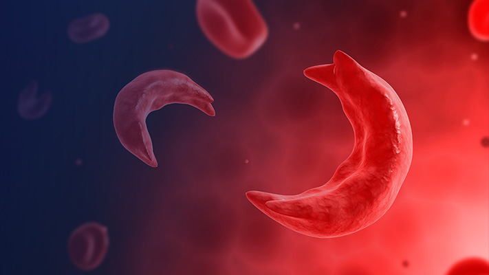 sickle cell disease