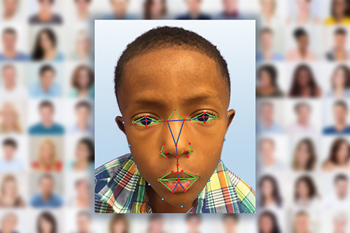 A young boy undergoes facial recognition software analysis for a possible diagnosis of DiGeorge syndrome
