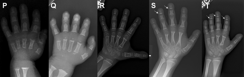 Hand X-Ray Images