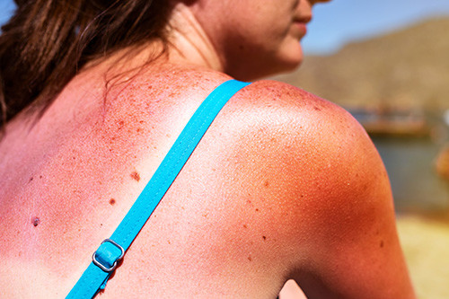 The back of a girl in a bathing suit with a sunburn