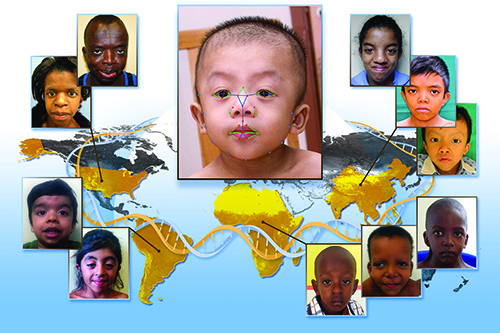 A variety of facial features, illustrated here, helped NIH researchers and their collaborators analyze white, African, Asian and Latin American children using a set of distances and angles between different landmarks on the face, and determine whether they had Noonan syndrome, a common genetic disease. Image Credit: Darryl Leja, NHGRI.