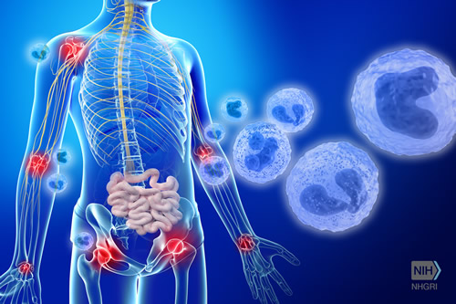 Inflammatory cells