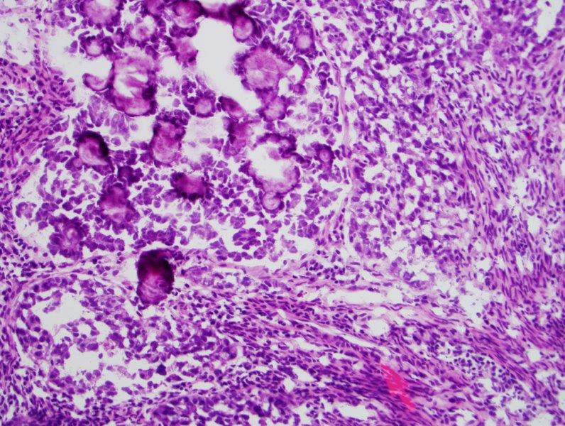 H&E stained section of a serous endometrial carcinoma. The credit: Maria J. Merino M.D., National Cancer Institute at NIH.