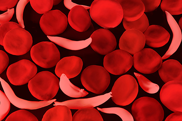 Sickle Cell Disease