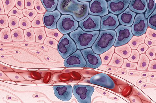 Growing cancer cells (in purple) are surrounded by healthy cells (in pink), illustrating a primary tumor spreading to other parts of the body through the circulatory system. Image credit: Darryl Leja, NHGRI.