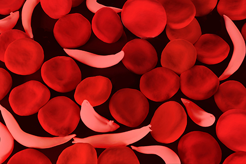 Sickle cells