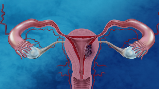 Endometrial Cancer