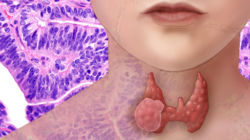 Thyroid Cancer