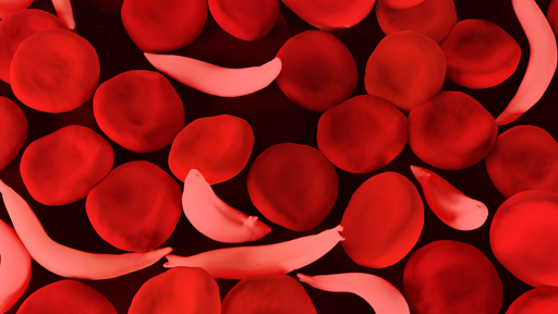 Sickle cell blood cells