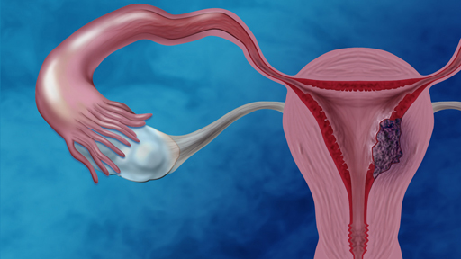 endometrial cancer