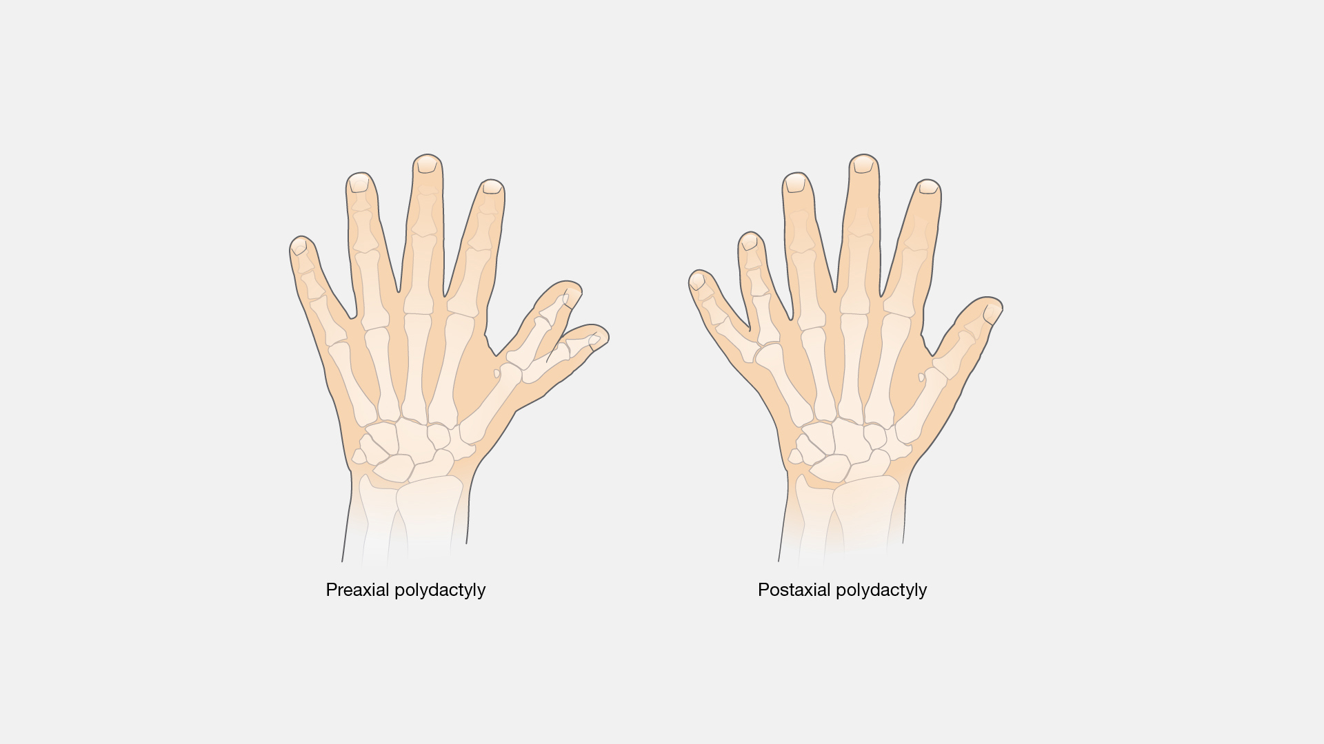  Polydactyly