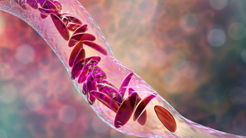 Sickle cell anemia, 3D illustration. Clumps of sickle cell block the blood vessel