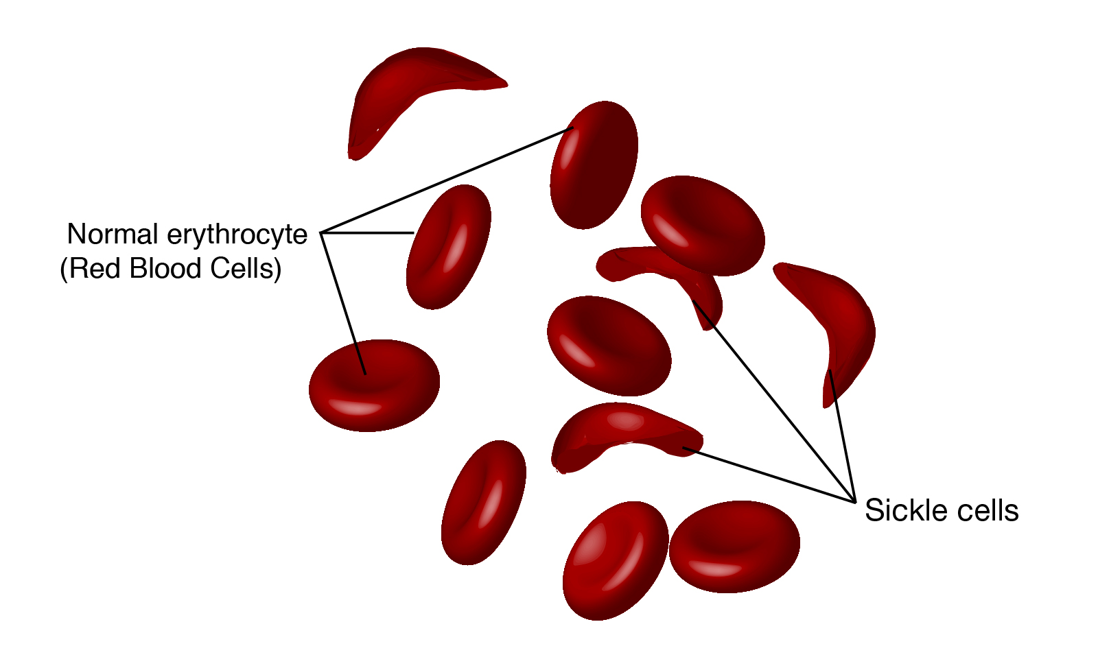 Afdæk relæ Vores firma Sickle Cell Disease