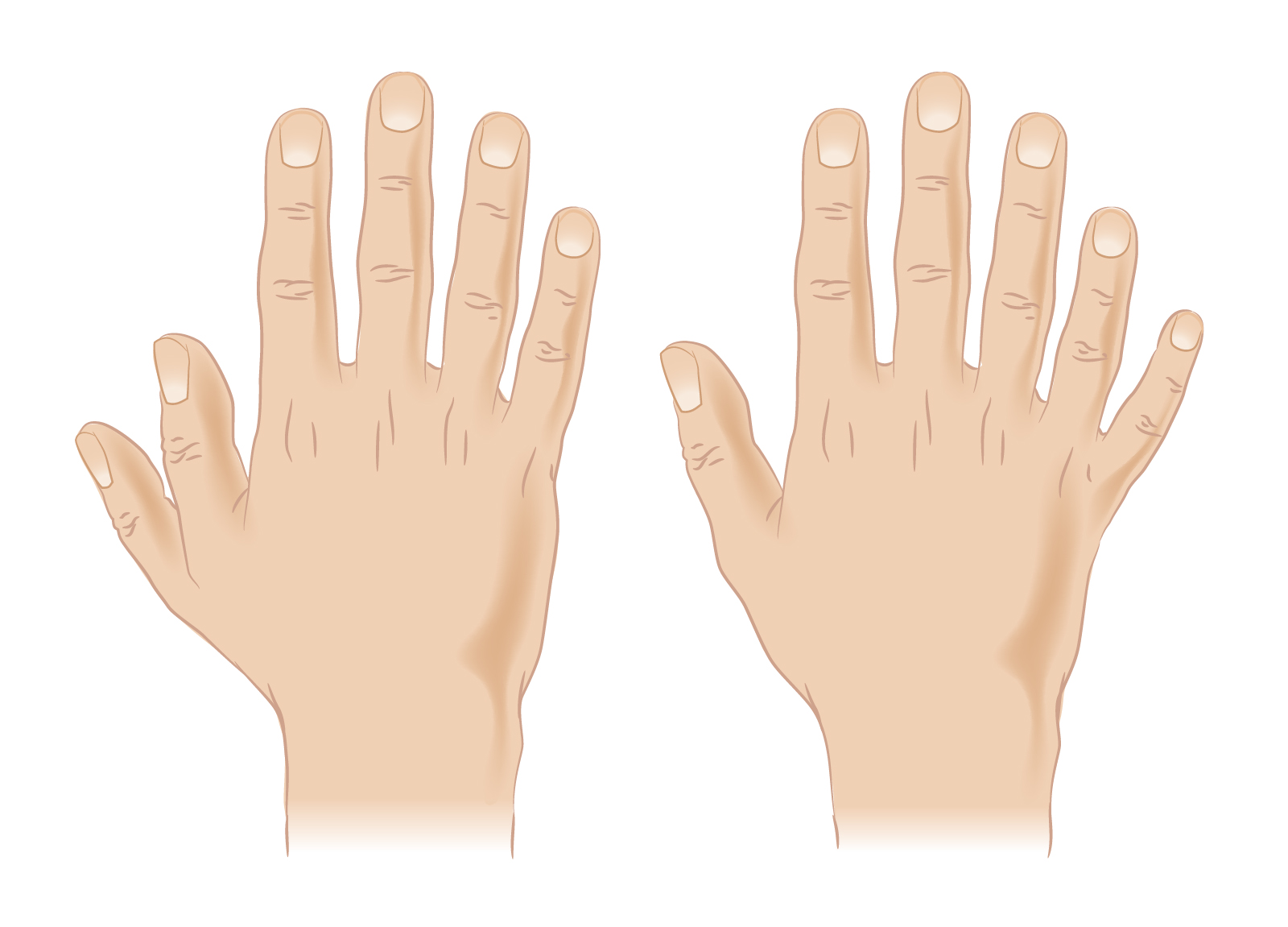 Polidactilia